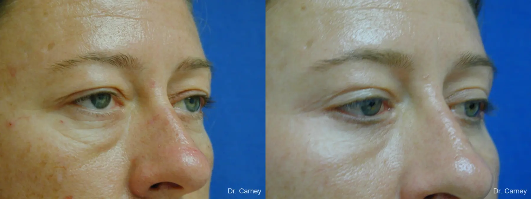 Virginia Beach Eyelid Lift 1209 - Before and After 2