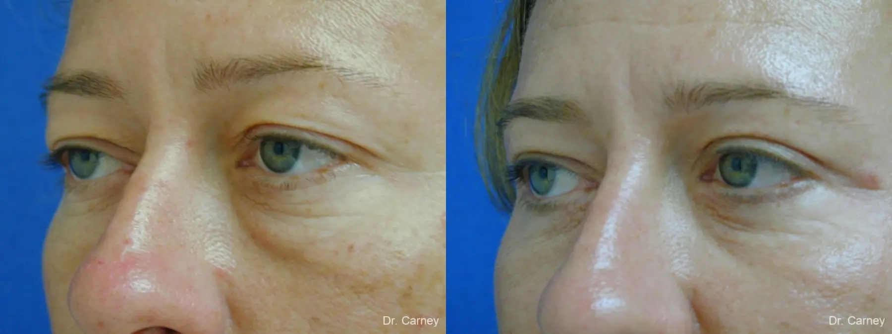 Virginia Beach Eyelid Lift 1209 - Before and After 3