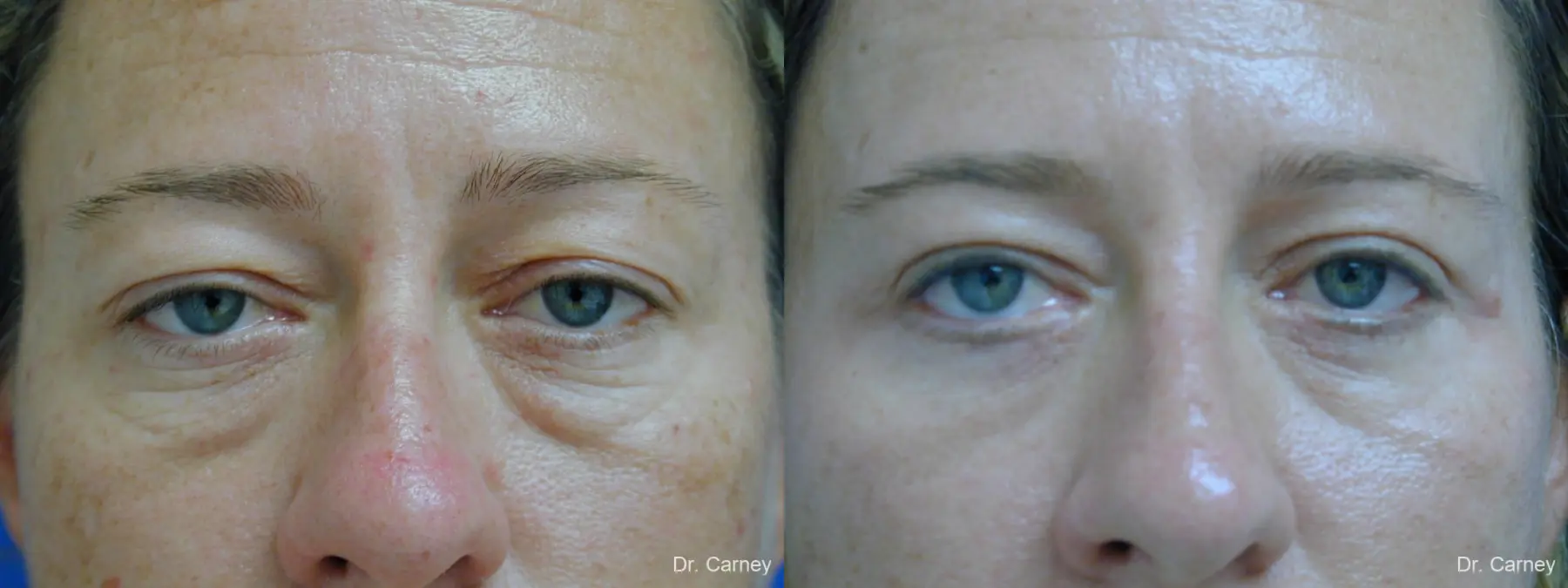Virginia Beach Eyelid Lift 1209 - Before and After 1