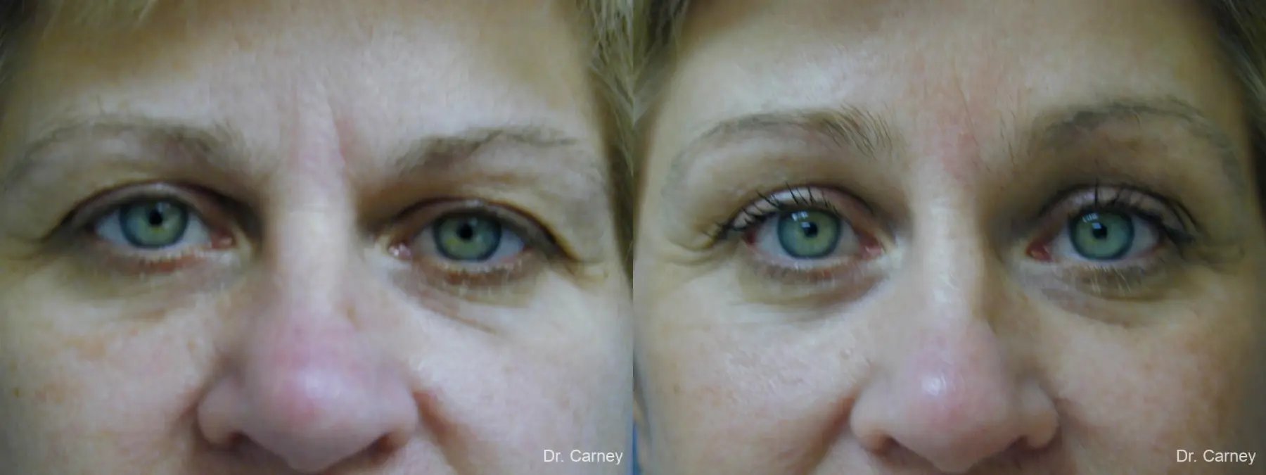 Virginia Beach Eyelid Lift 1344 - Before and After 2