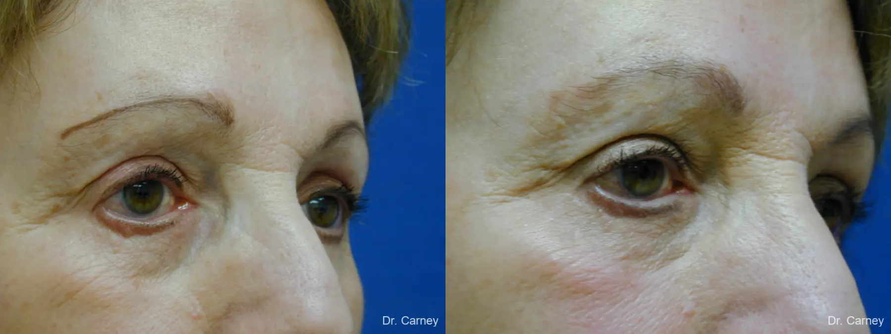 Virginia Beach Eyelid Lift 1128 - Before and After 2