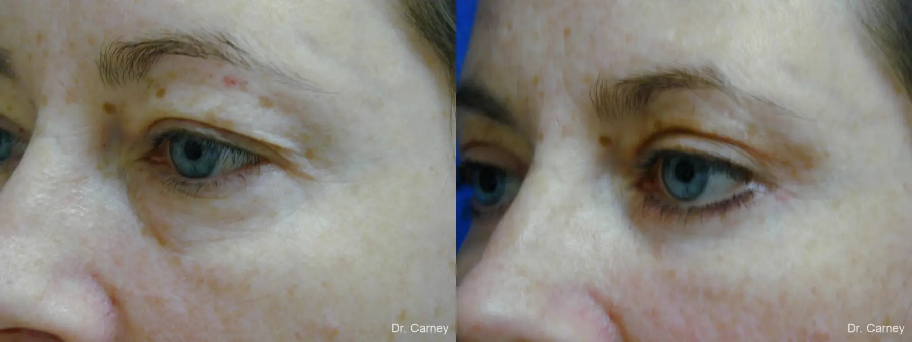Virginia Beach Eyelid Lift 1138 - Before and After 3