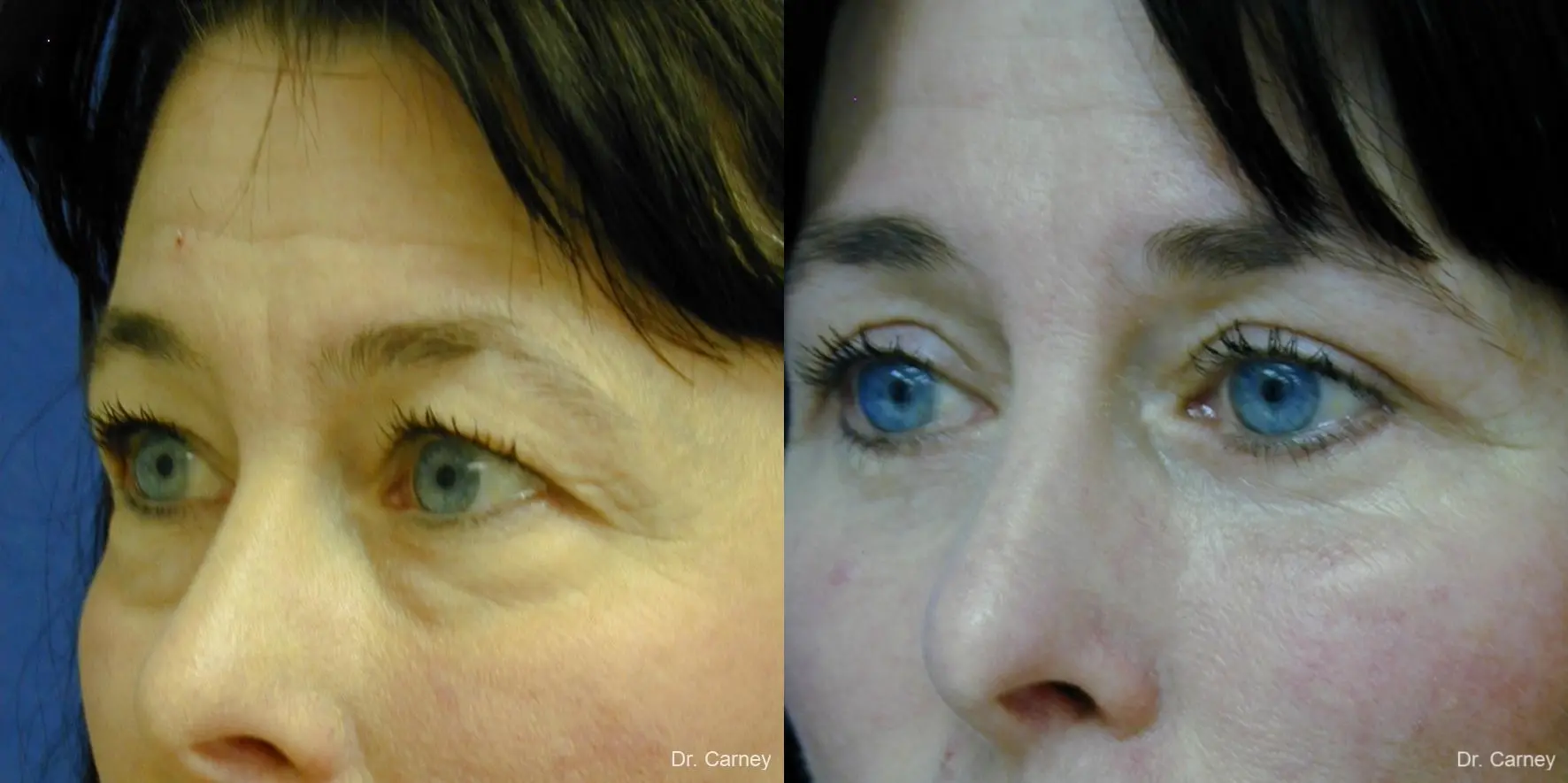 Virginia Beach Eyelid Lift 1139 - Before and After 3