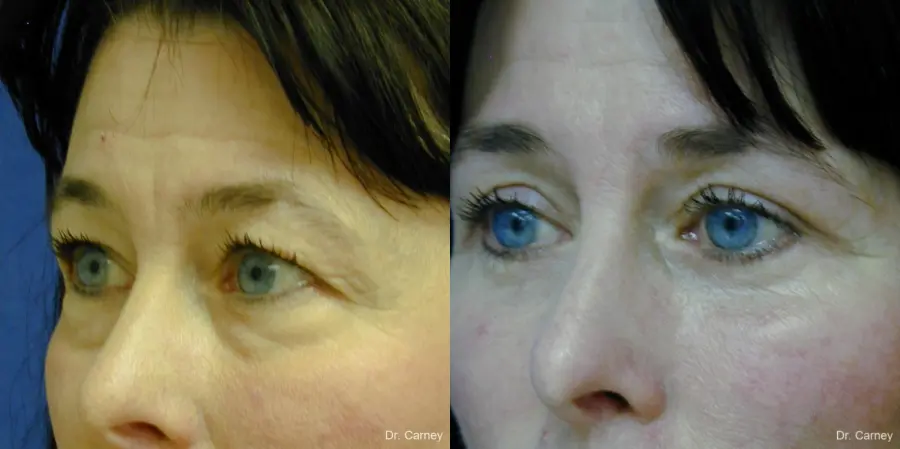 Virginia Beach Eyelid Lift 1139 - Before and After 3