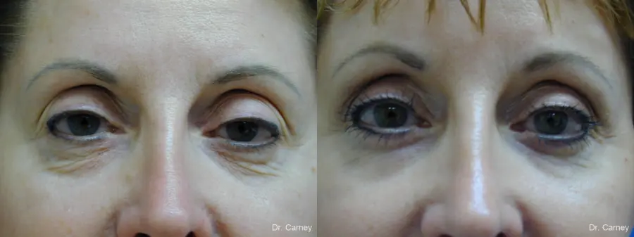 Virginia Beach Eyelid Lift 1131 - Before and After 1