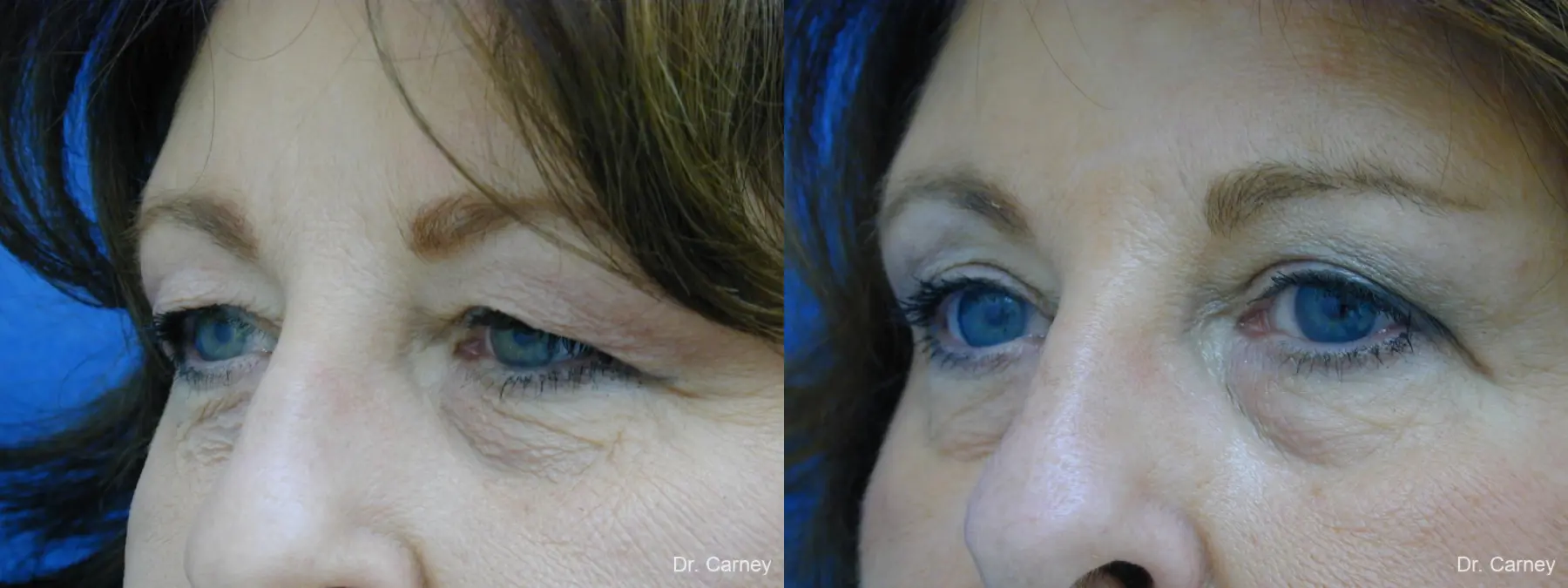 Virginia Beach Eyelid Lift 1129 - Before and After 3