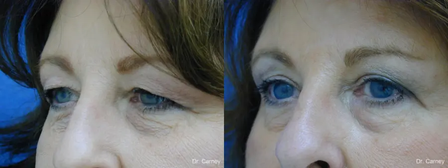 Virginia Beach Eyelid Lift 1129 - Before and After 3