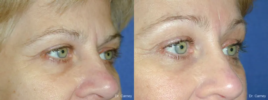 Virginia Beach Eyelid Lift 1344 - Before and After 4