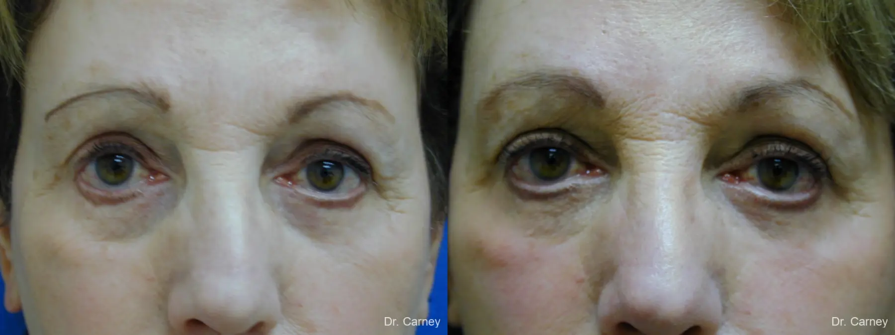 Virginia Beach Eyelid Lift 1128 - Before and After 1