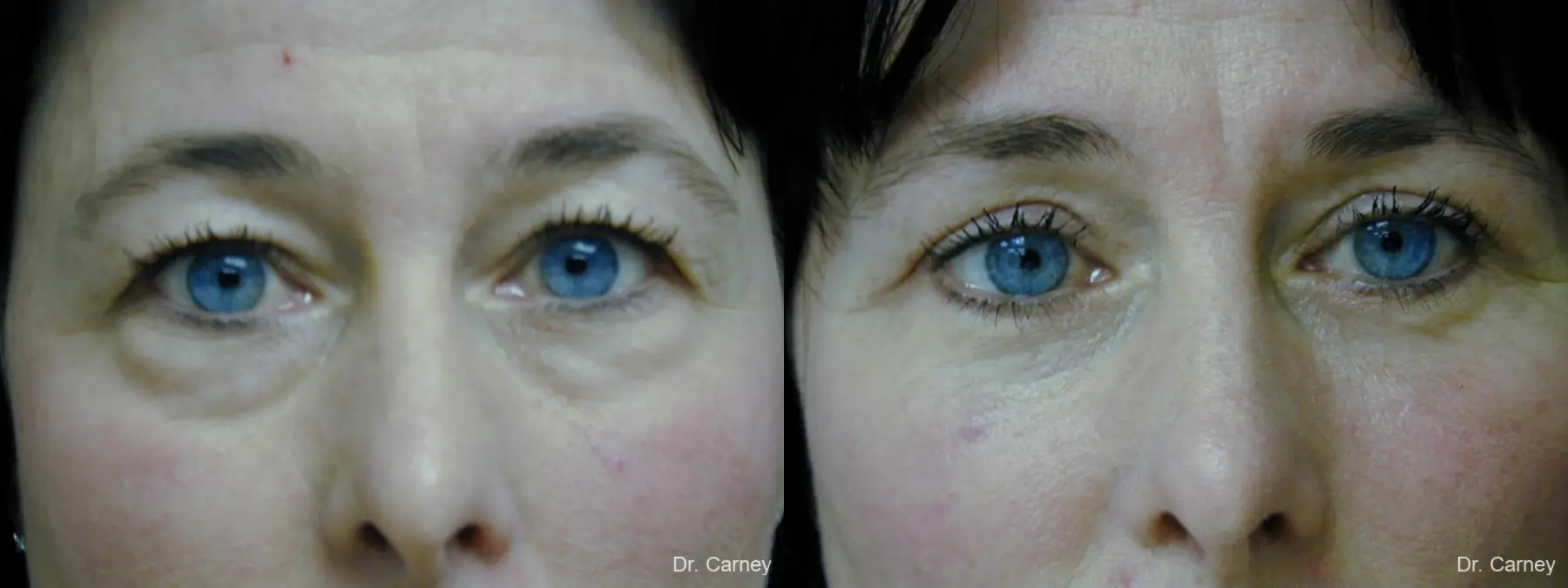 Virginia Beach Eyelid Lift 1139 - Before and After