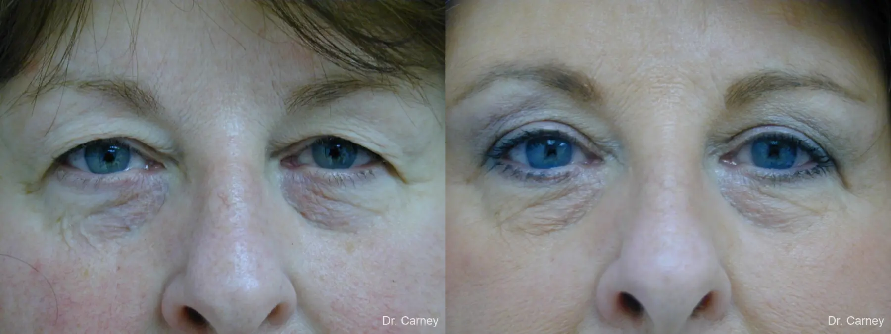 Virginia Beach Eyelid Lift 1129 - Before and After 1