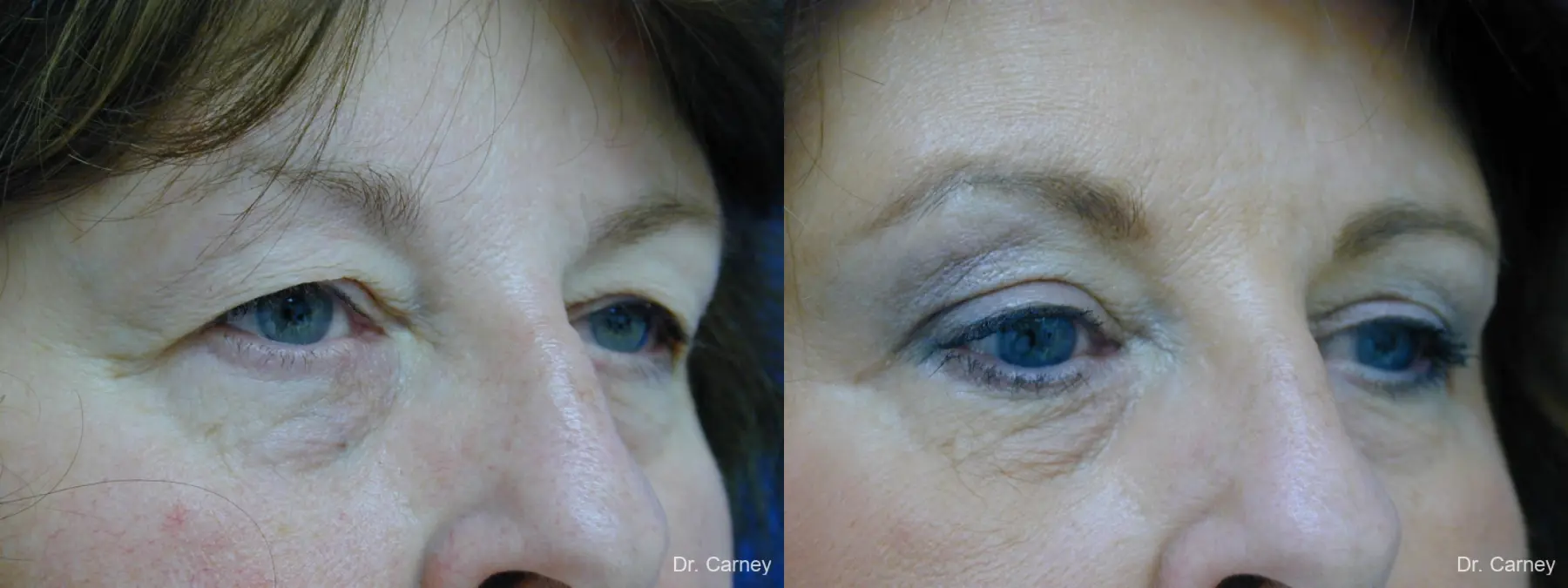 Virginia Beach Eyelid Lift 1129 - Before and After 2