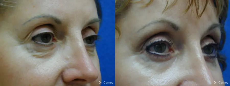 Virginia Beach Eyelid Lift 1131 - Before and After 2