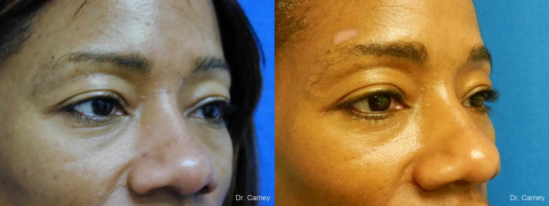 Virginia Beach Eyelid Lift 1130 - Before and After