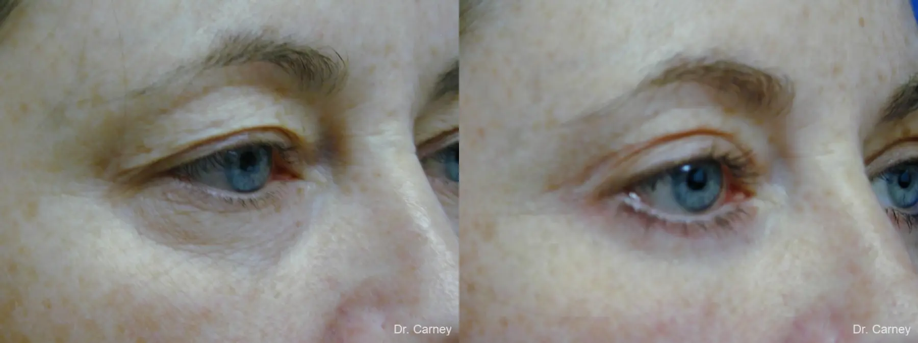 Virginia Beach Eyelid Lift 1138 - Before and After 2