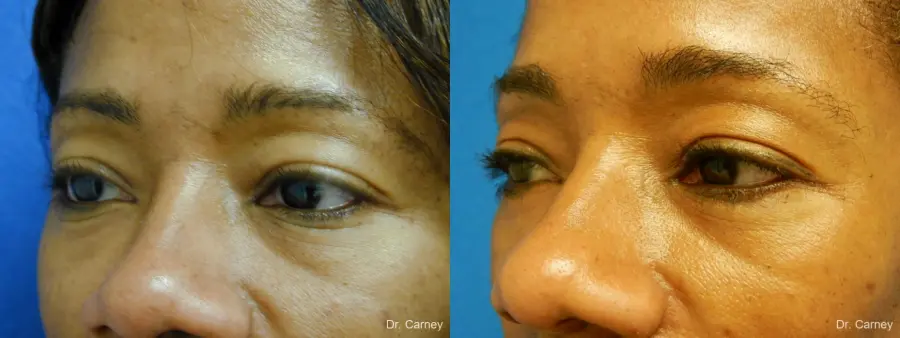 Virginia Beach Eyelid Lift 1130 - Before and After 2