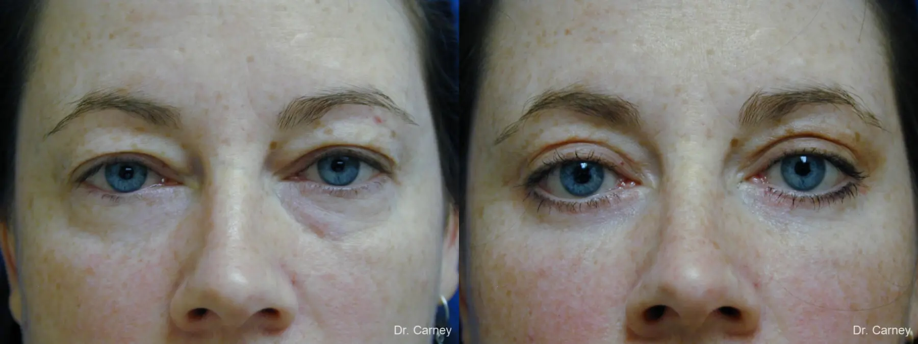 Virginia Beach Eyelid Lift 1138 - Before and After 1