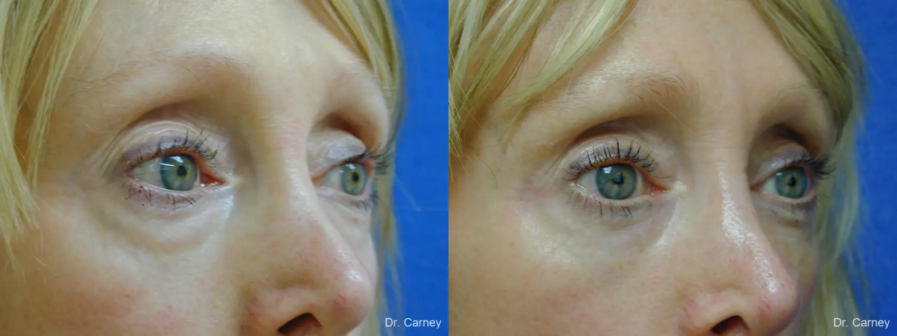 Virginia Beach Eyelid Lift 1079 - Before and After 2