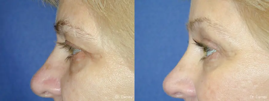 Virginia Beach Eyelid Lift 1344 - Before and After 5