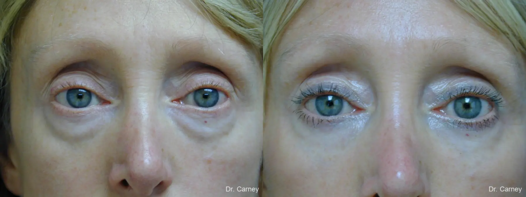 Virginia Beach Eyelid Lift 1079 - Before and After