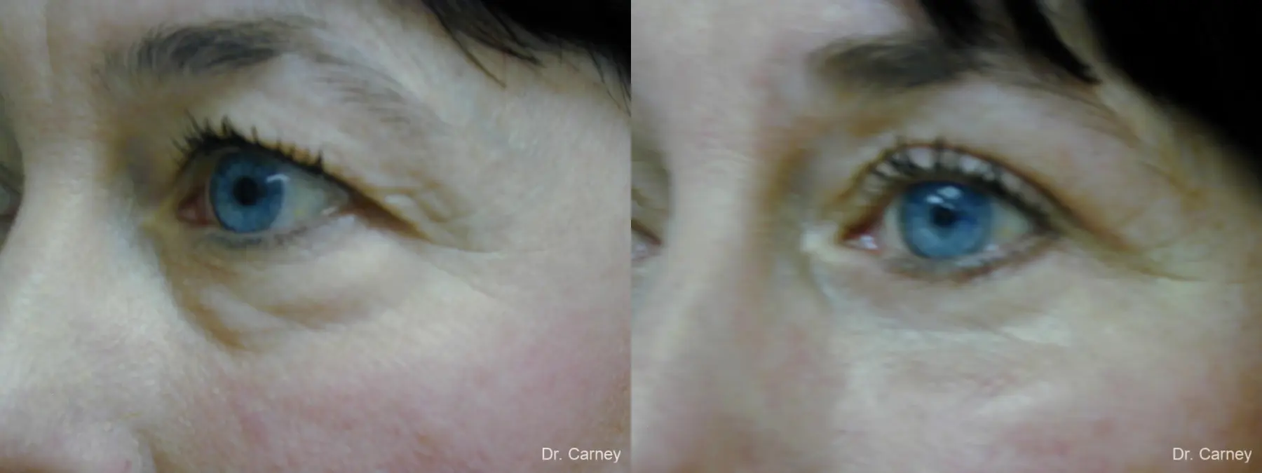 Virginia Beach Eyelid Lift 1139 - Before and After 2