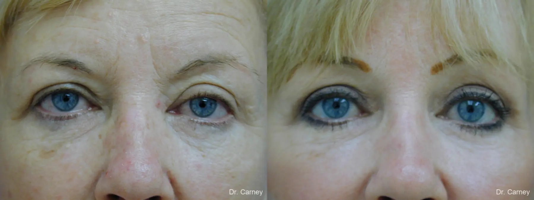 Virginia Beach Eyelid Lift 1265 - Before and After