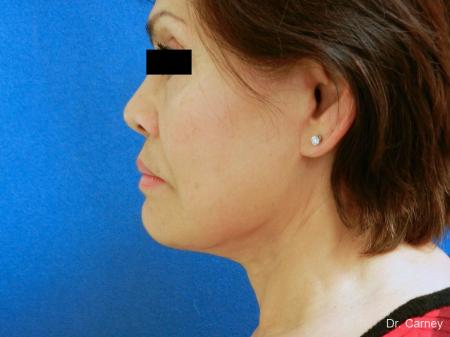 Virginia Beach Neck Lift 1268 - After Image 3