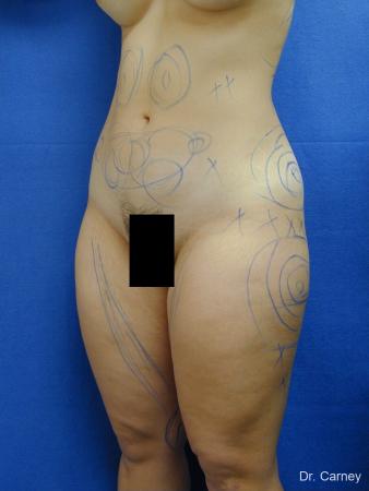 Virginia Beach Liposuction 1276 - Before and After Image 5