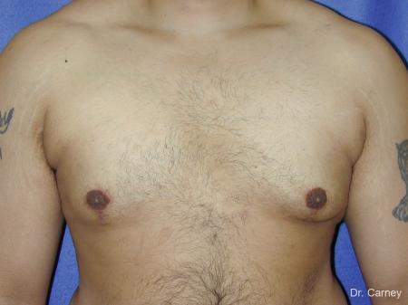 Virginia Beach Gynecomastia 1255 - After Image 1
