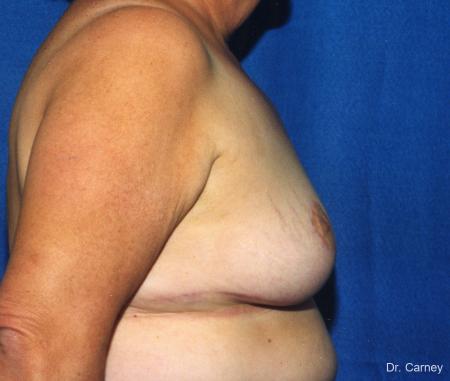 Virginia Beach Breast Lift 1186 - After Image 2