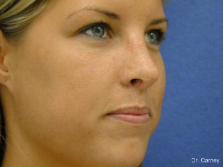 Virginia Beach Rhinoplasty 1218 - After Image 4