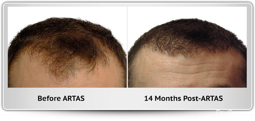 Hair Transplantation: Patient 2 - Before and After 1