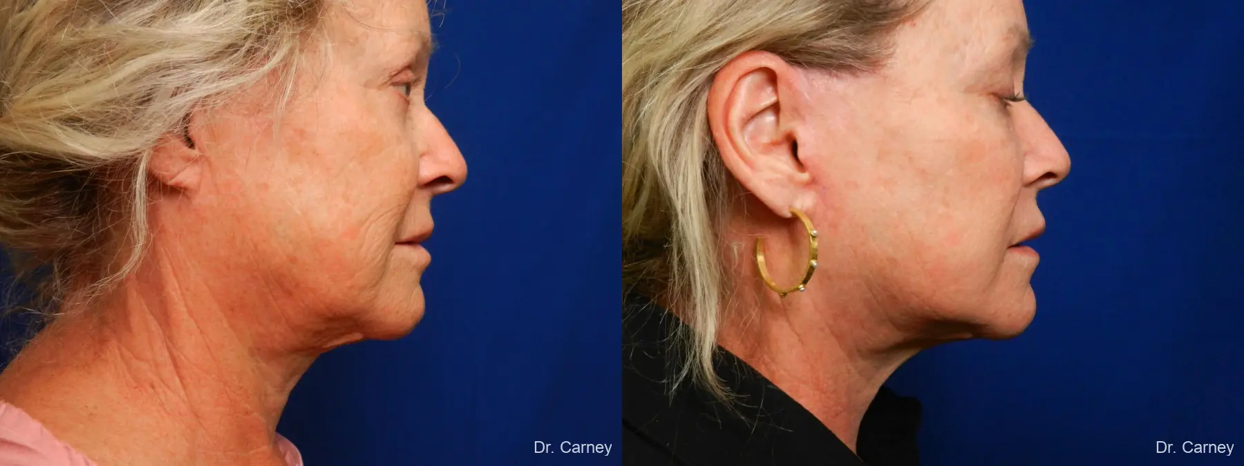 Facelift: Patient 9 - Before and After 3