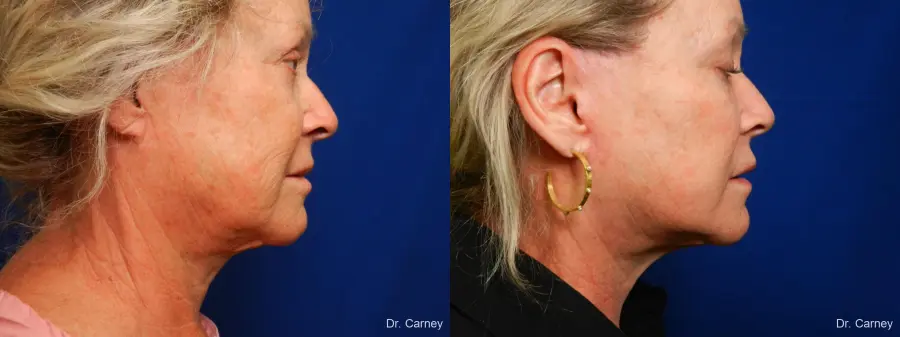 Facelift: Patient 9 - Before and After 3
