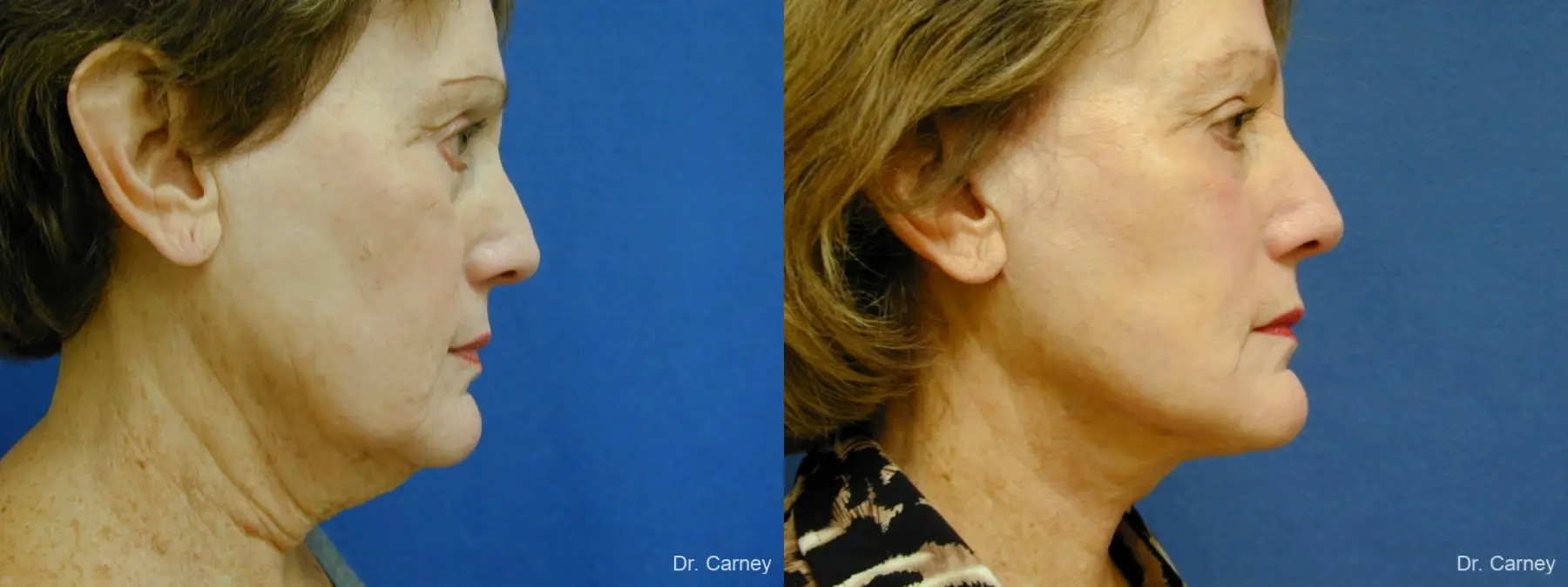 Virginia Beach Facelift 1133 - Before and After