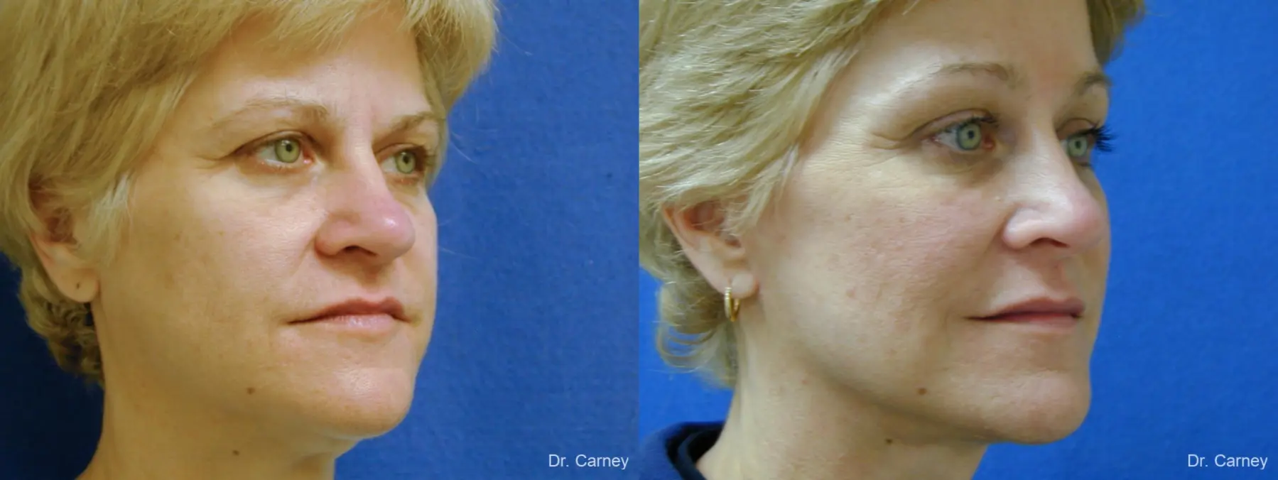 Virginia Beach Facelift 1346 - Before and After 2