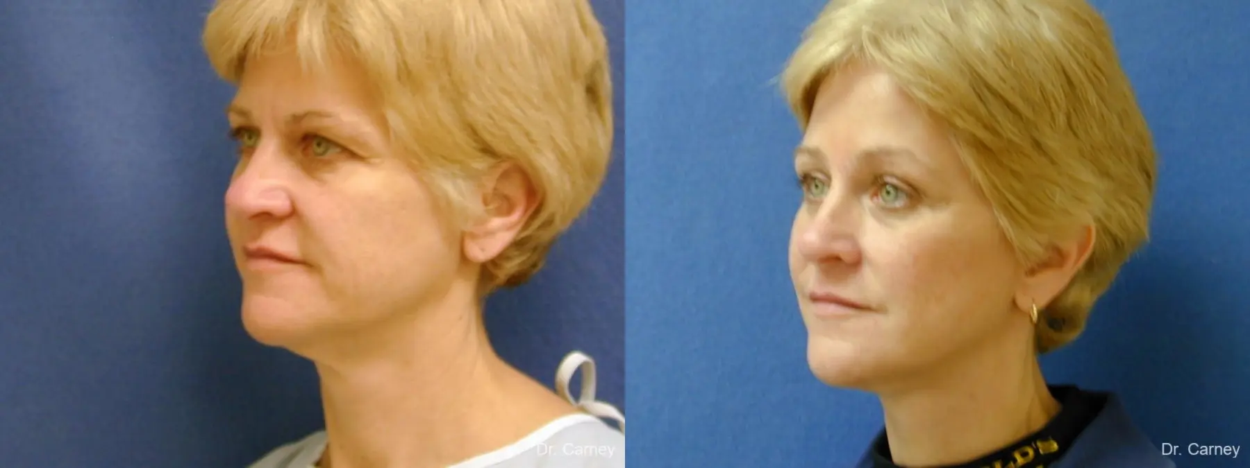 Virginia Beach Facelift 1346 - Before and After 3