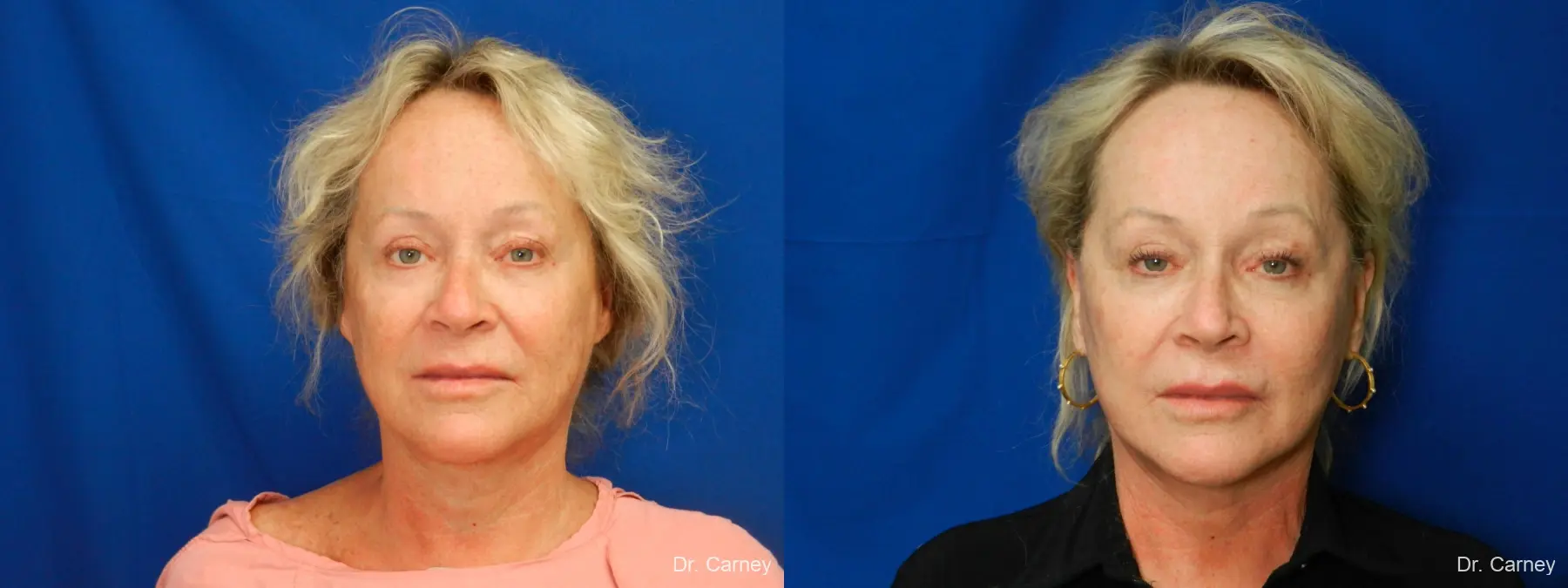 Facelift: Patient 9 - Before and After  