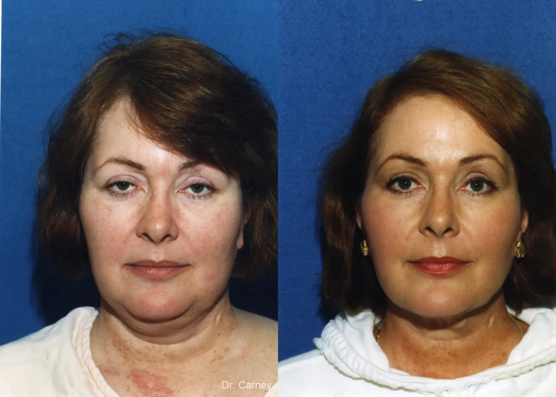Virginia Beach Facelift 1137 - Before and After 2