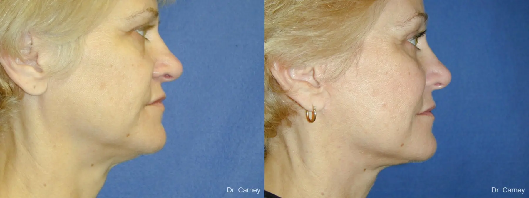 Virginia Beach Facelift 1346 - Before and After 5