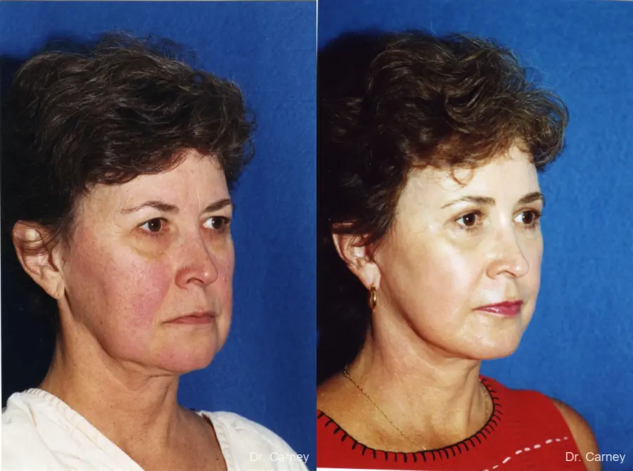 Virginia Beach Facelift 1134 - Before and After 1