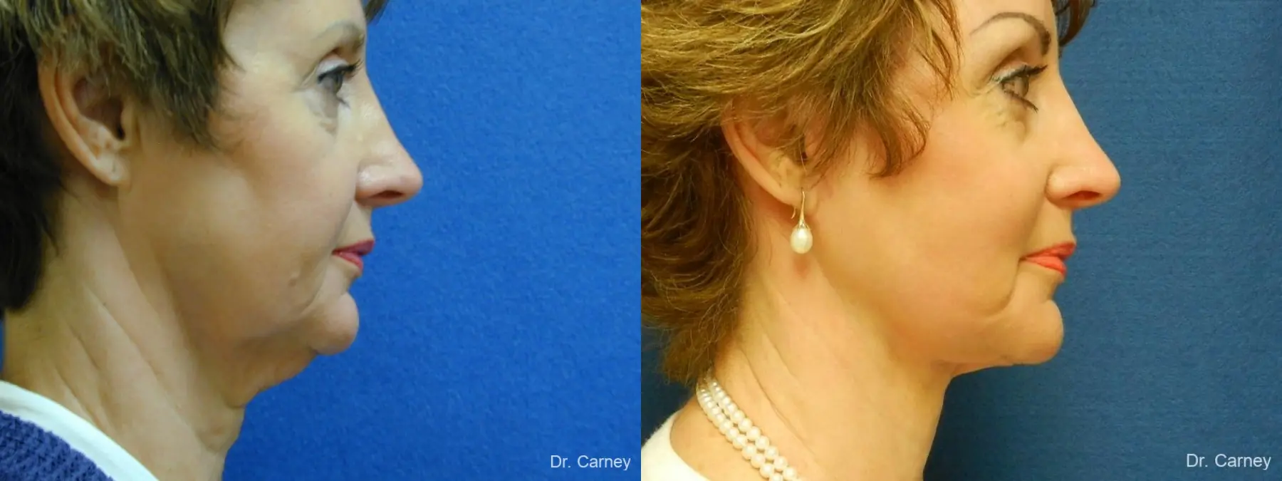 Virginia Beach Facelift 1132 - Before and After 3