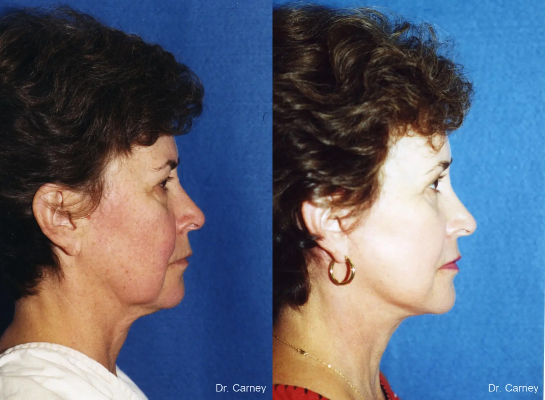 Virginia Beach Facelift 1134 - Before and After 2
