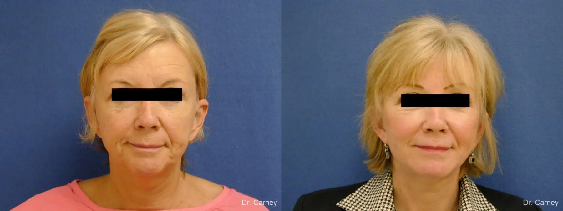 Virginia Beach Facelift 1262 - Before and After 1