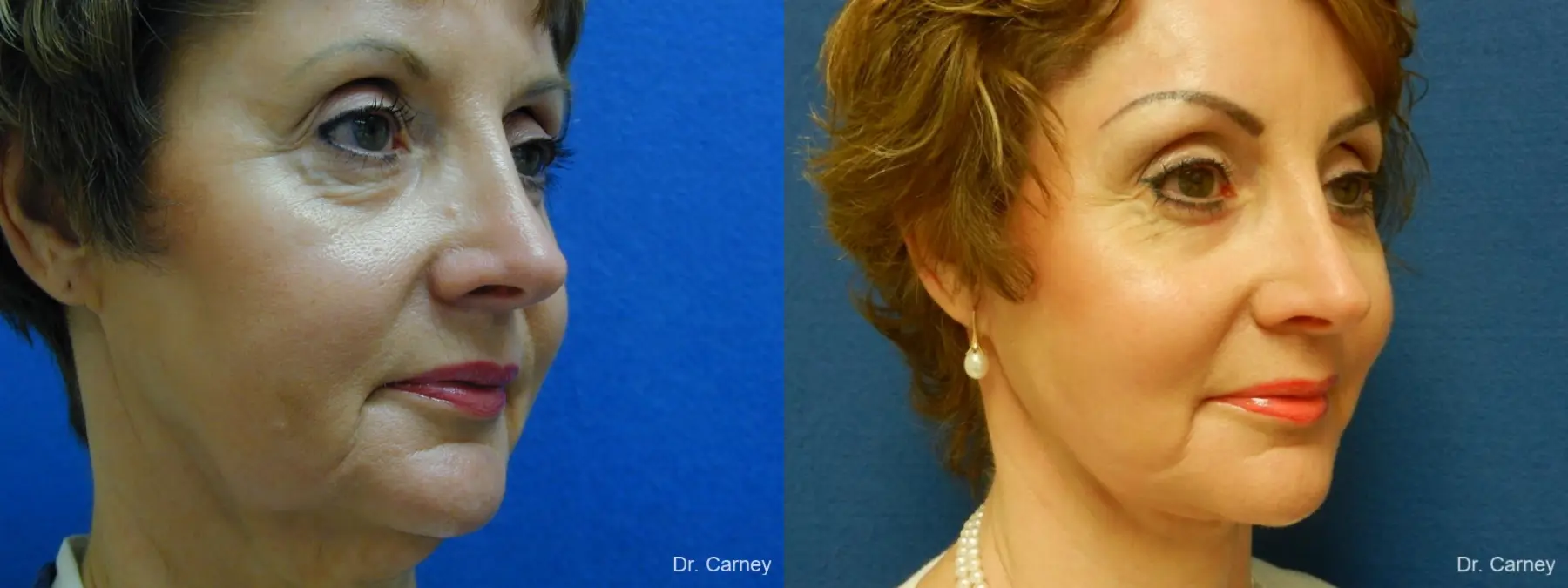 Virginia Beach Facelift 1132 - Before and After 2