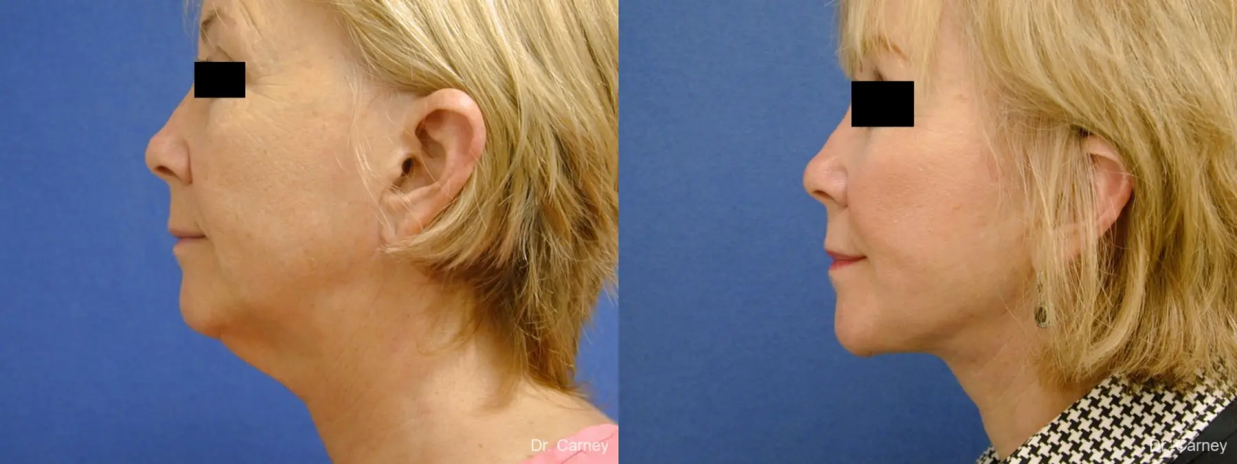Virginia Beach Facelift 1262 - Before and After 5