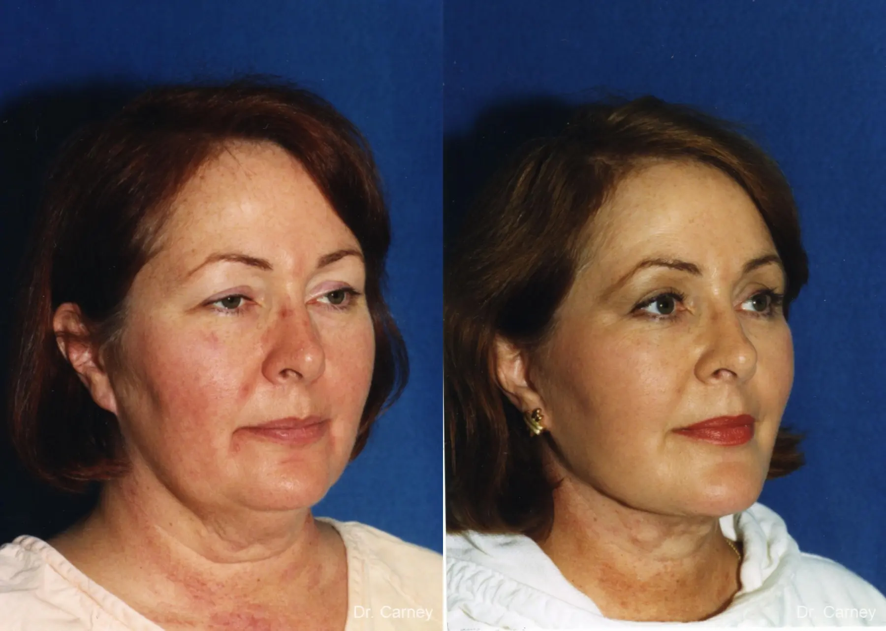 Virginia Beach Facelift 1137 - Before and After