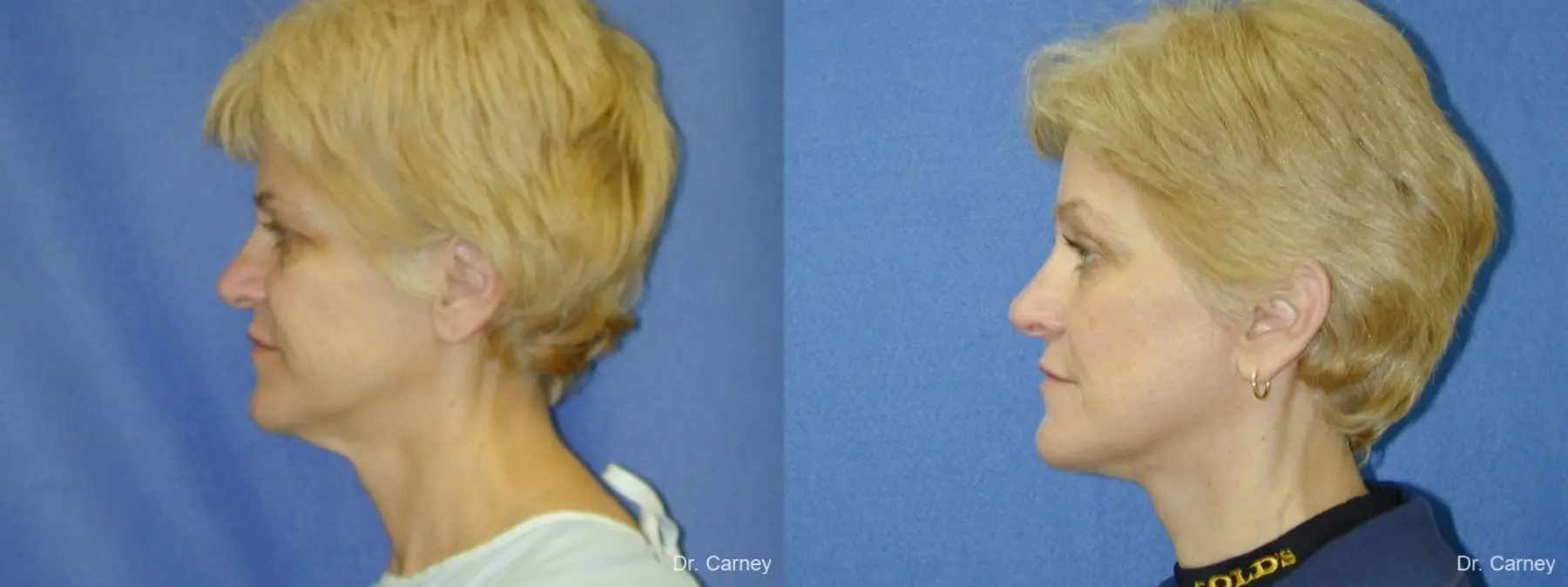 Virginia Beach Facelift 1346 - Before and After 4