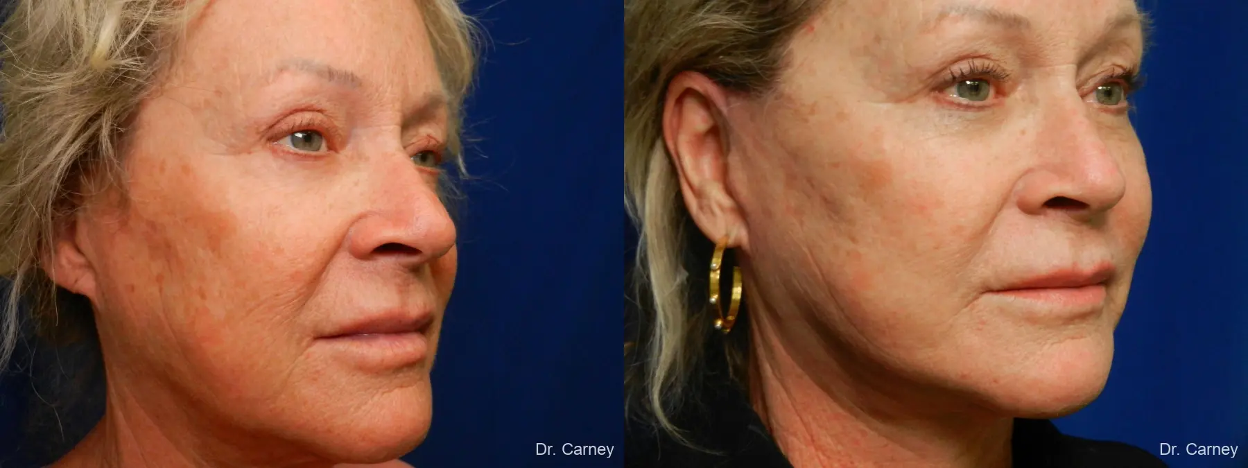 Facelift: Patient 9 - Before and After 2