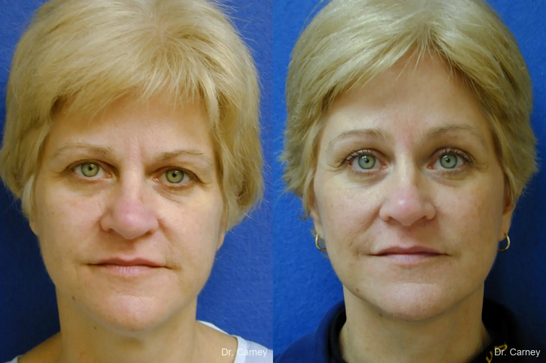 Virginia Beach Facelift 1346 - Before and After 1